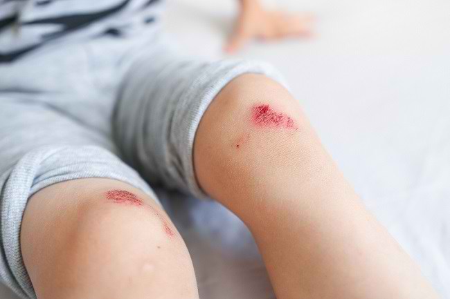 Pemulihan Luka Maksimal bila Tahu Cara Minum Yochanna yang Tepat