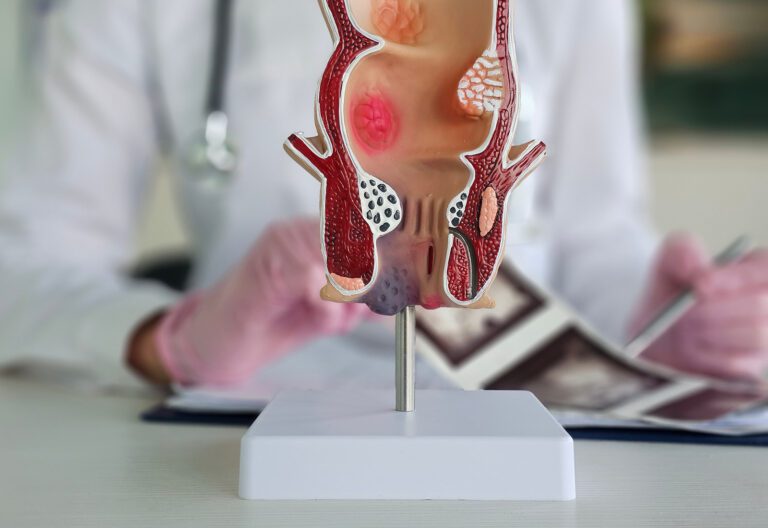 hemotera - Kenali Wasir Luar, Masalah di Area Anus yang Sering Diabaikan