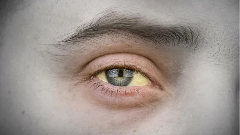 herbatitis-Hepatitis Apa Bisa Sembuh Ketahui Cara Pulihkan Liver Dengan Benar