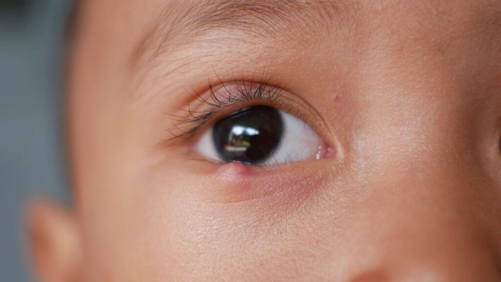 ometa-Obat Mata Bintitan Aman untuk Dewasa dan Anak-Anak