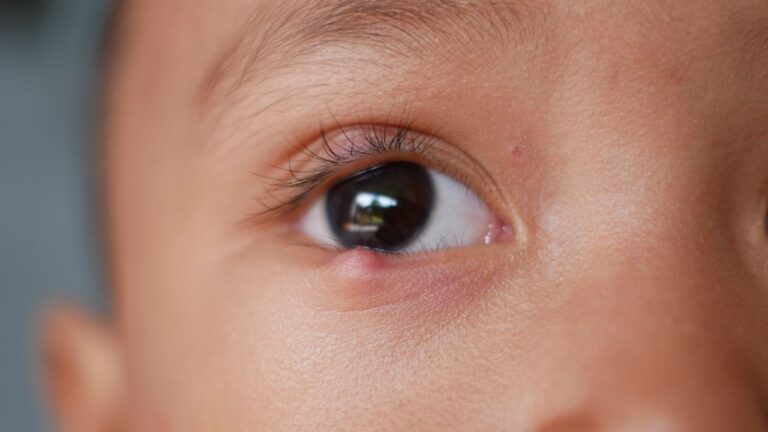 ometa-Obat Mata Bintitan Aman untuk Dewasa dan Anak-Anak