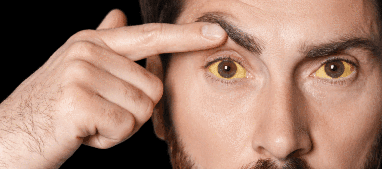 Gejala Hepatitis yang Harus Diwaspadai Sejak Dini